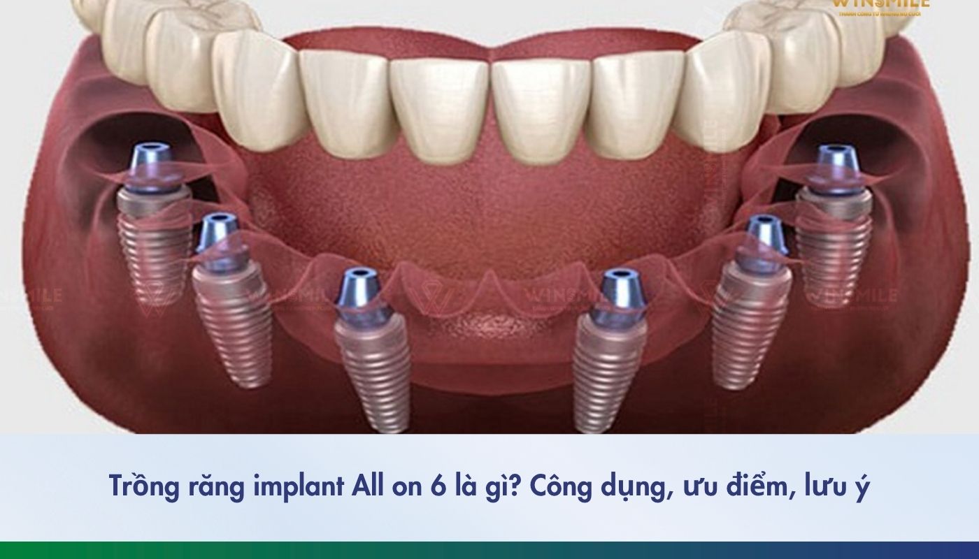 Trồng răng implant All on 6 là gì? Công dụng, ưu điểm, lưu ý