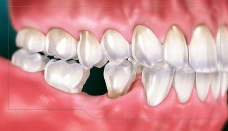 phương pháp trồng răng implant All on 6 cũng tồn tại một số hạn chế