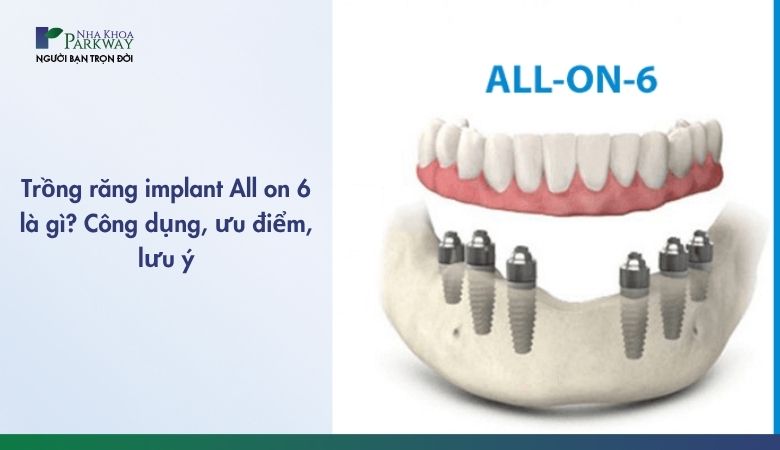 Trồng răng implant All on 6 là giải pháp phục hình răng tiên tiến
