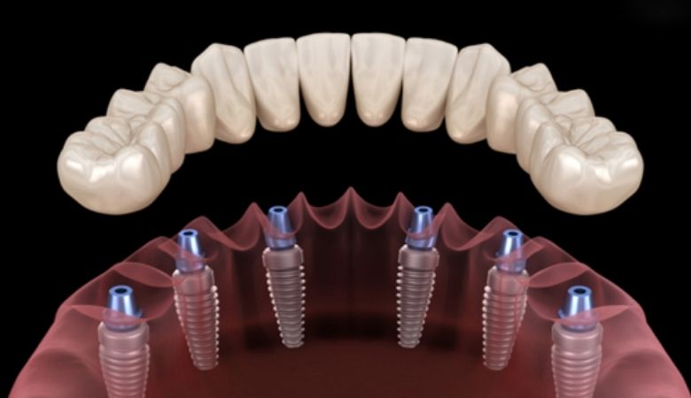 Ưu điểm của phương pháp trồng răng All on 6