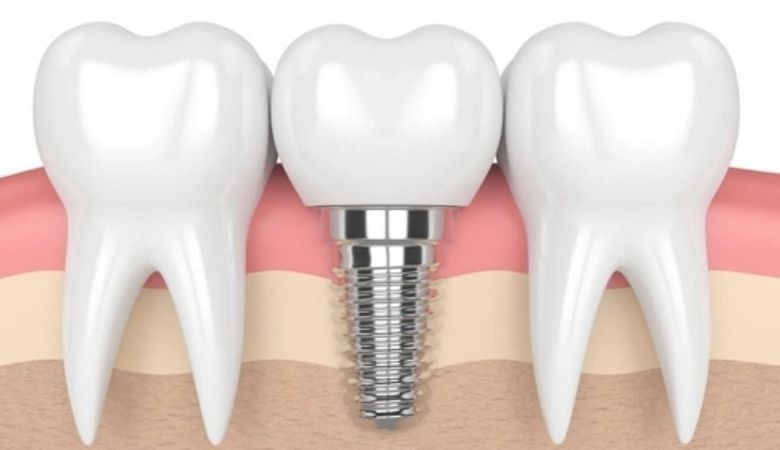 Mỗi loại trụ có đặc điểm riêng, phù hợp với nhu cầu và điều kiện của từng bệnh nhân.