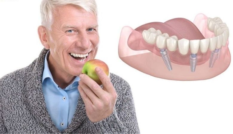 Trồng răng implant All on 6 khôi phục khả năng ăn nhai lên đến hơn 90%
