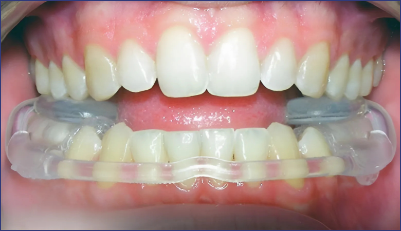 Máng chống nghiến răng - 1