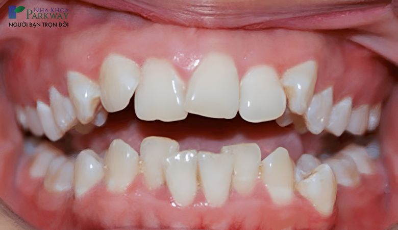 Răng mọc lệch do nguyên nhân chủ quan và khách quan