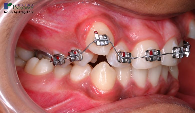 Niềng răng lệch lạc bằng mắc cài kim loại