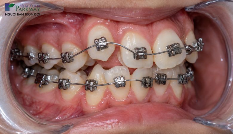 Niềng răng lệch lạc bằng mắc cài kim loại tự động