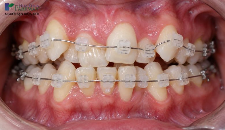 Niềng răng lệch lạc bằng mắc cài sứ