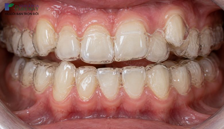 Niềng răng lệch lạc trong suốt Invisalign
