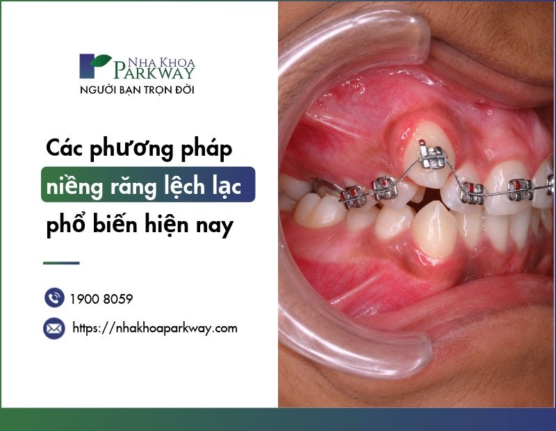 Các phương pháp niềng răng lệch lạc​ phổ biến hiện nay