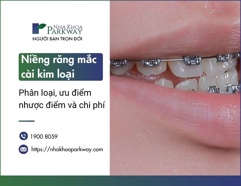 Niềng răng mắc cài kim loại là gì? Phân loại, ưu nhược điểm và chi phí
