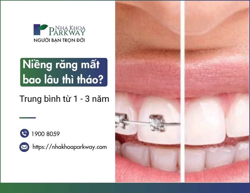 Niềng răng mất bao lâu thì tháo? Trung bình từ 1-3 năm