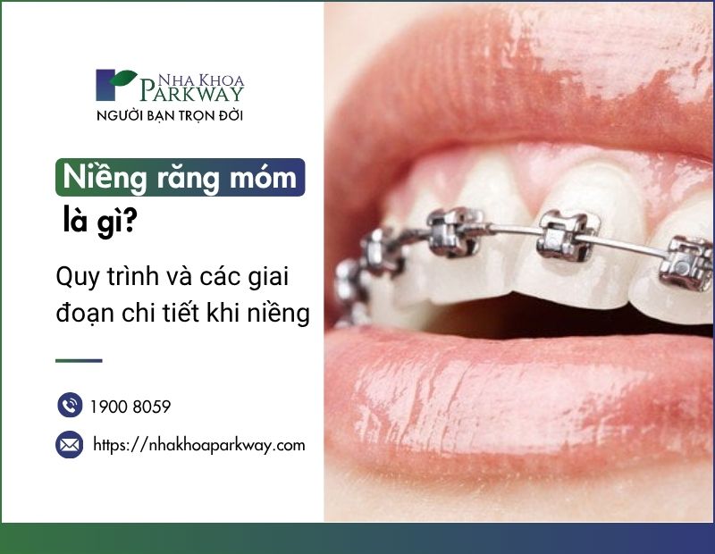 Niềng răng móm là gì? Quy trình và các giai đoạn chi tiết khi niềng