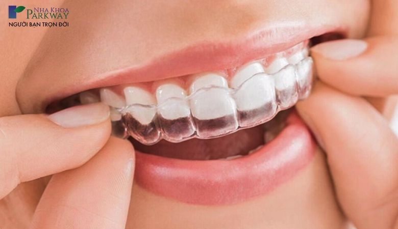 Niềng răng trong suốt Invisalign là gì?
