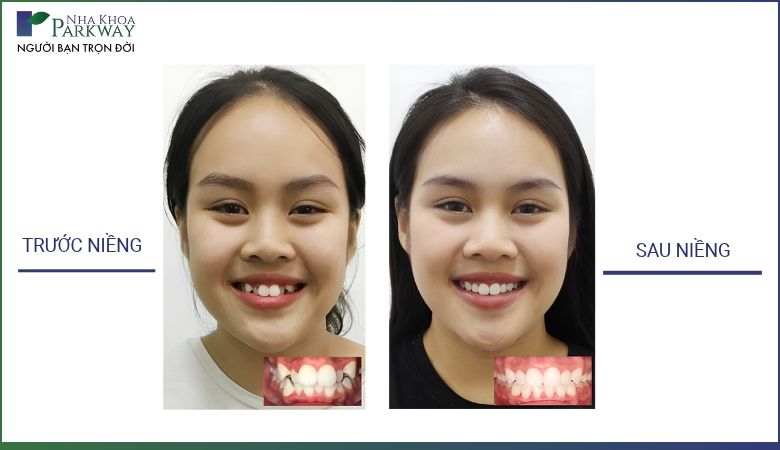 Ảnh so sánh trước và sau khi niềng răng trong suốt Invisalign tại Nha khoa Parkway