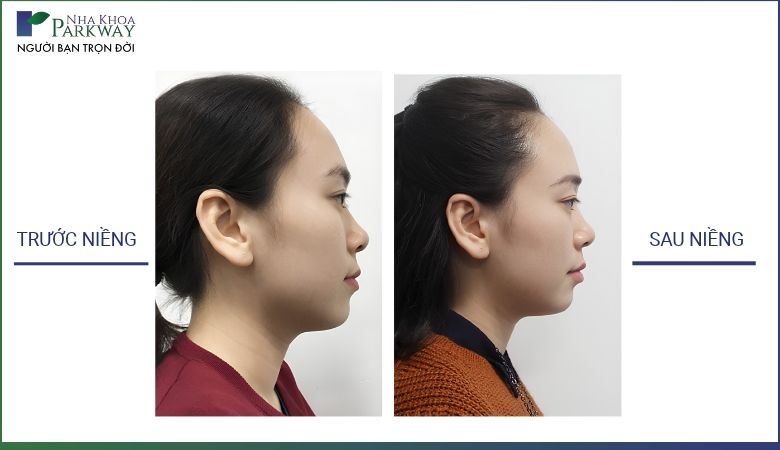 Kết quả niềng răng Invisalign trước và sau ở góc nghiêng giúp cải thiện nét mặt tại Nha khoa Parkway