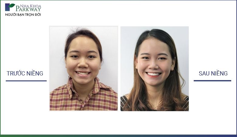 Sự thay đổi khớp cắn và cung răng đều đẹp của khách hàng sau khi niềng răng